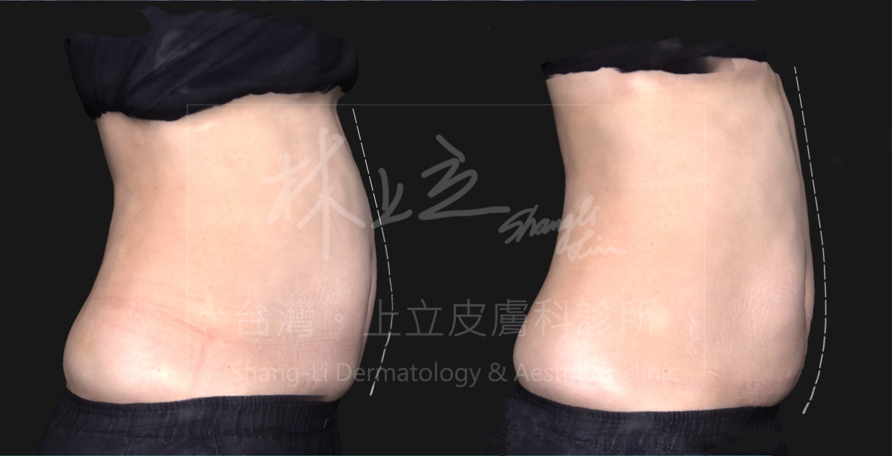 SculpSure絲酷秀（體外雷射溶脂）可以明顯改善腹部肥胖的問題，同時腹部仍然維持緊實。