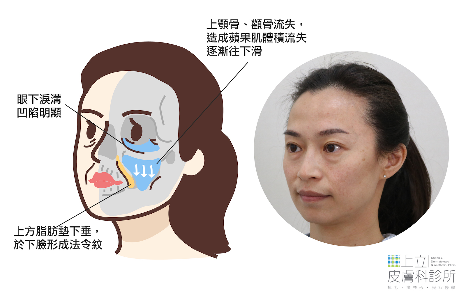 老化後淚溝凹陷