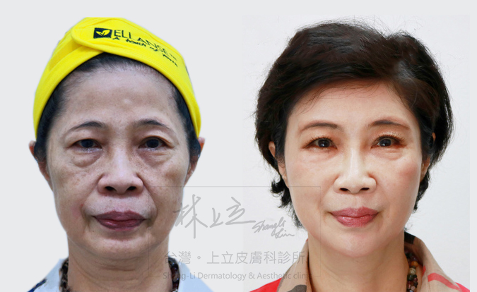 林上立醫師運用「Shang Lift上立提（液態拉皮）」的技術重建流失的骨架支撐