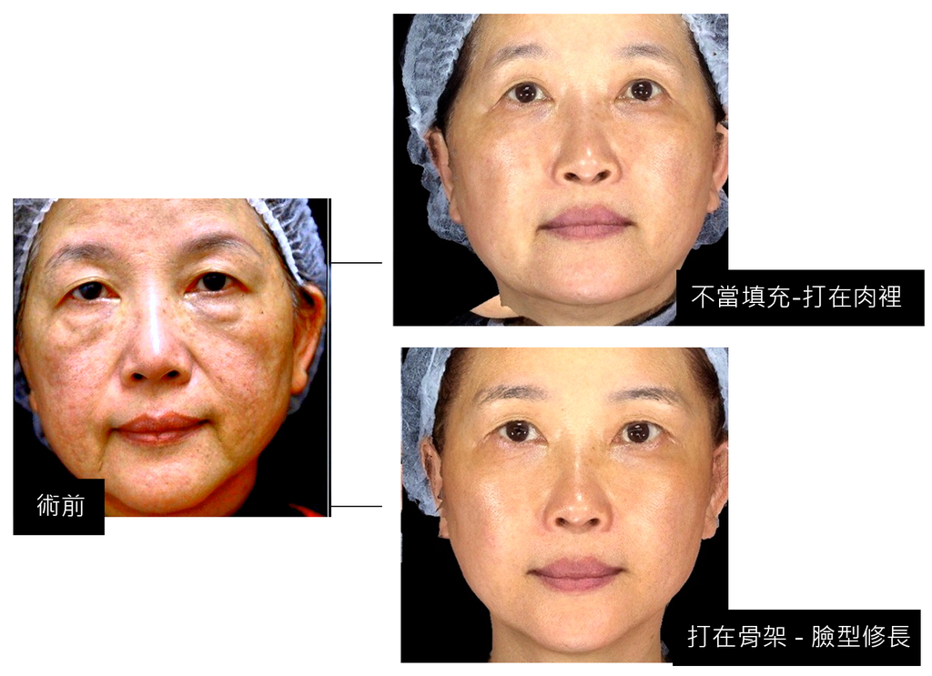 填充不當案例