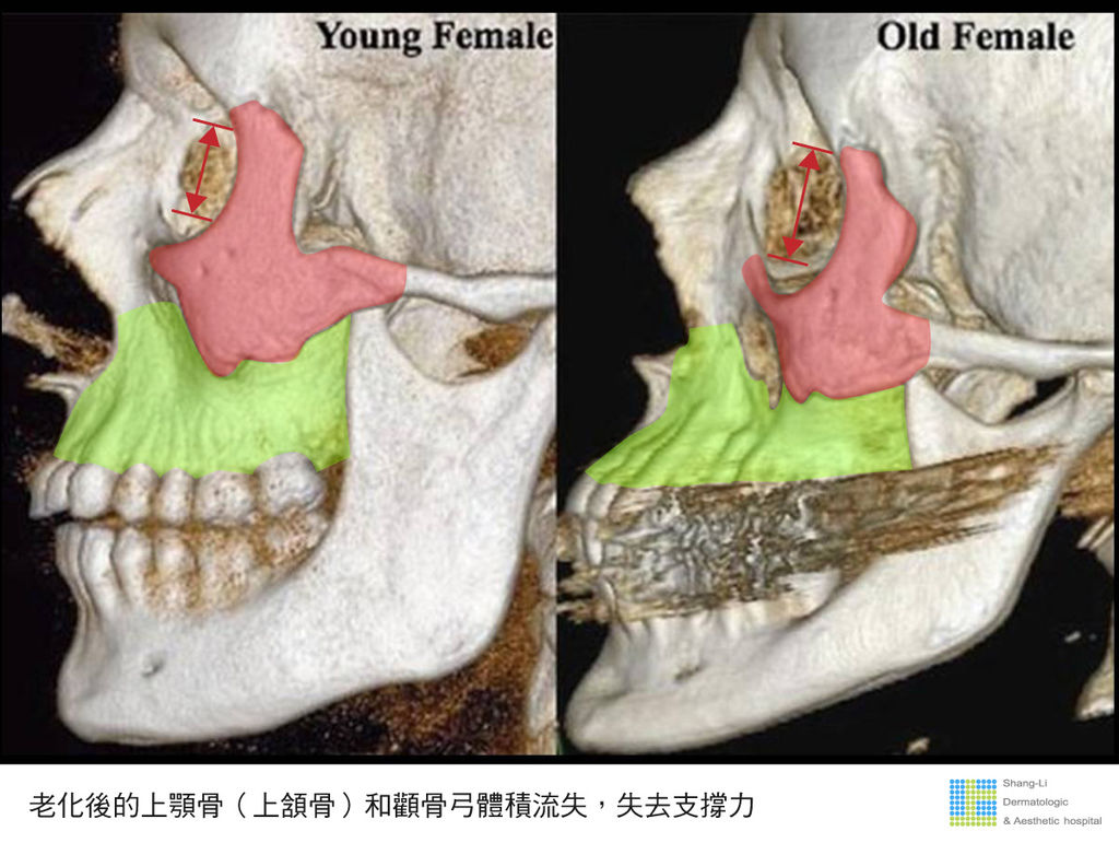 老化造成法令紋原因