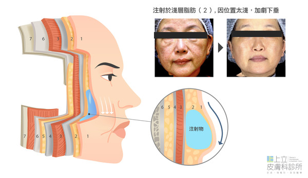 注射位置說明