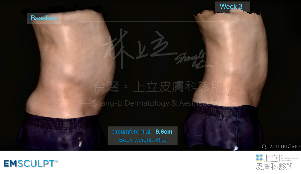 EMSCULPT肌動減脂３周２小時治療後隨著腰腹肌肉量增加原本的水桶腰明顯小了一圈