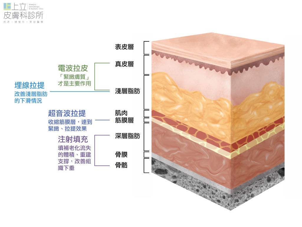 埋線拉提的作用原理
