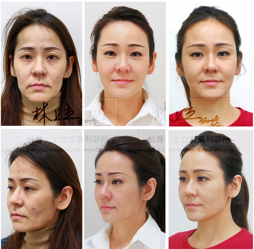 上立醫美Ellans&eacute;洢蓮絲術前術後比較