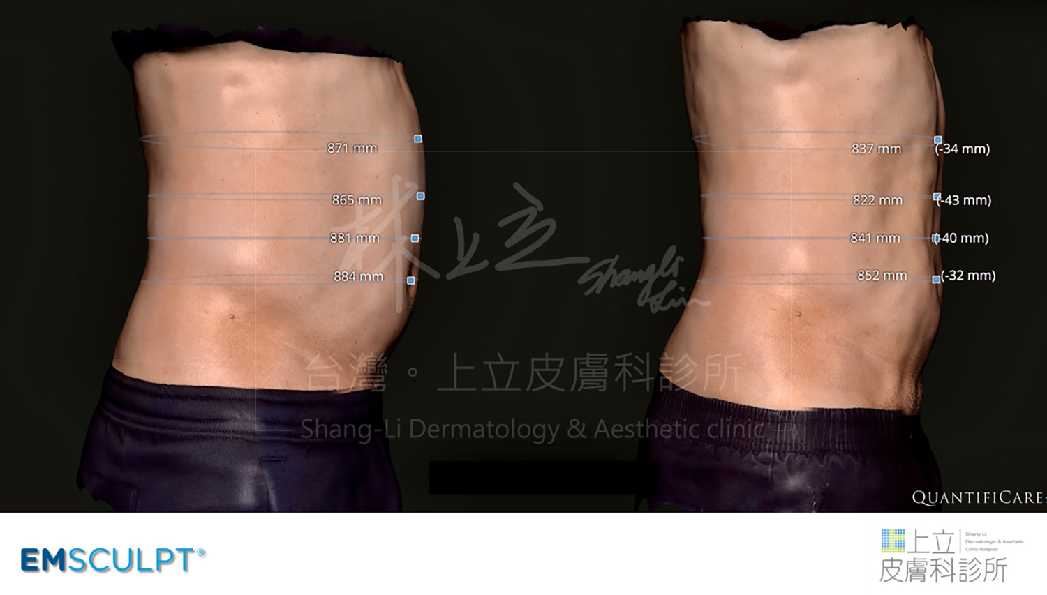EMSCULPT肌動減脂可以有效鍛鍊EMSCULPT肌動減脂2小時治療之後，原本突出的腹部消失，身形線條緊實勻稱。