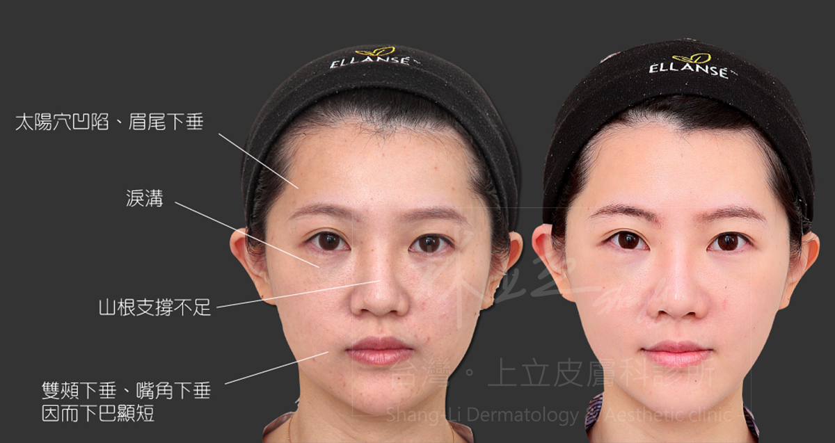 Ellans&eacute;洢蓮絲術前術後比較&lsquo;