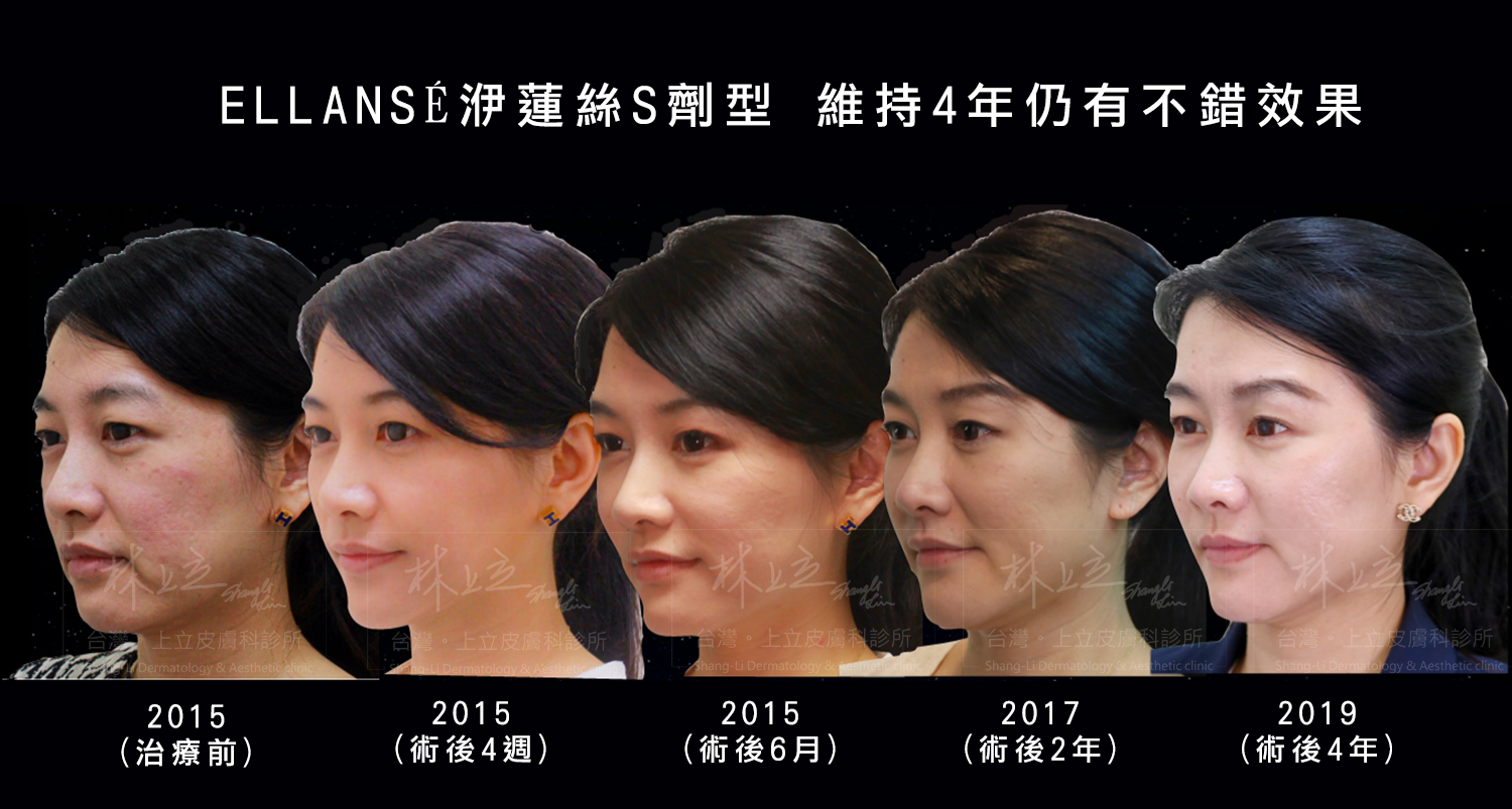 Ellans&eacute;洢蓮絲維持效果