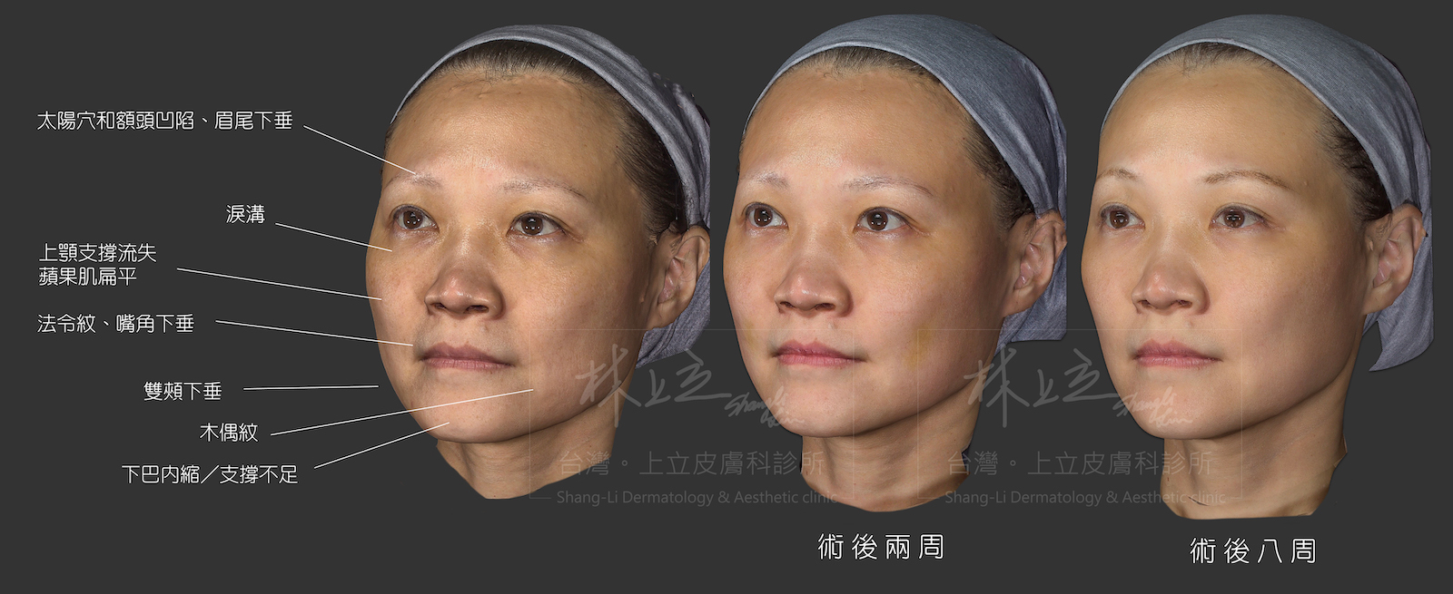 林上立醫師的AestheFill艾麗斯（聚雙旋乳酸）治療案例