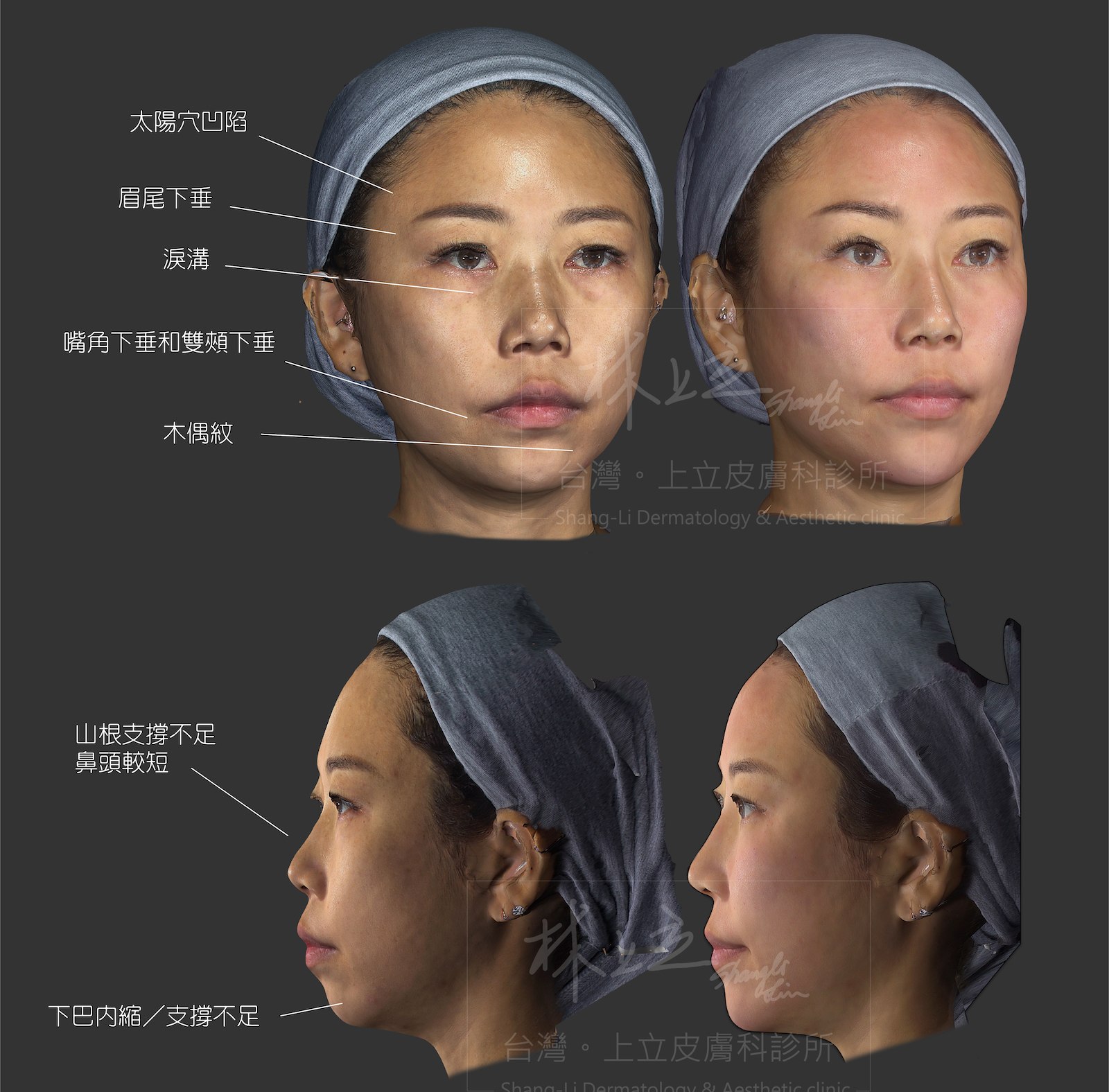 林上立醫師的AestheFill艾麗斯（聚雙旋乳酸）案例分析