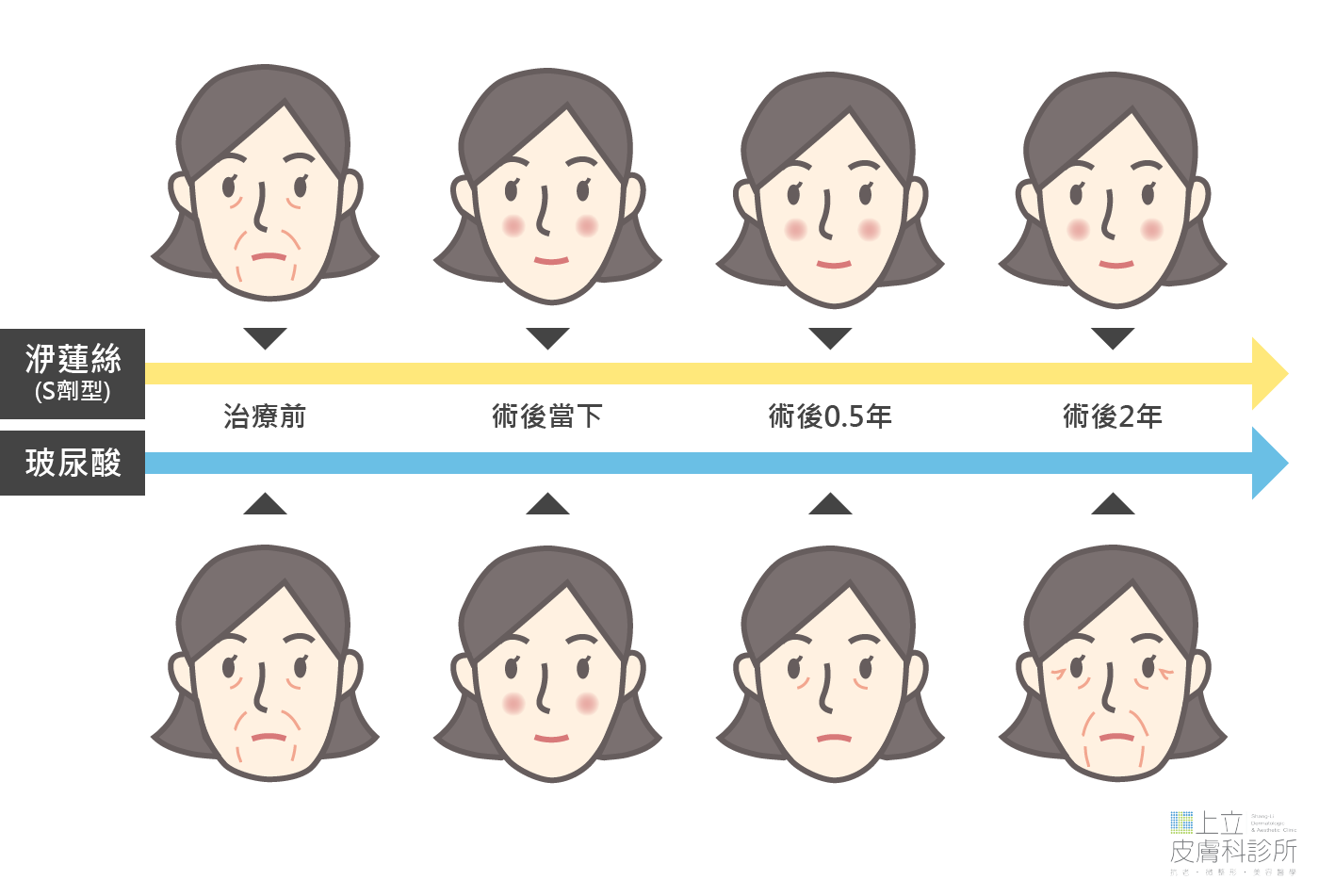 洢蓮絲和玻尿酸術後效果比較