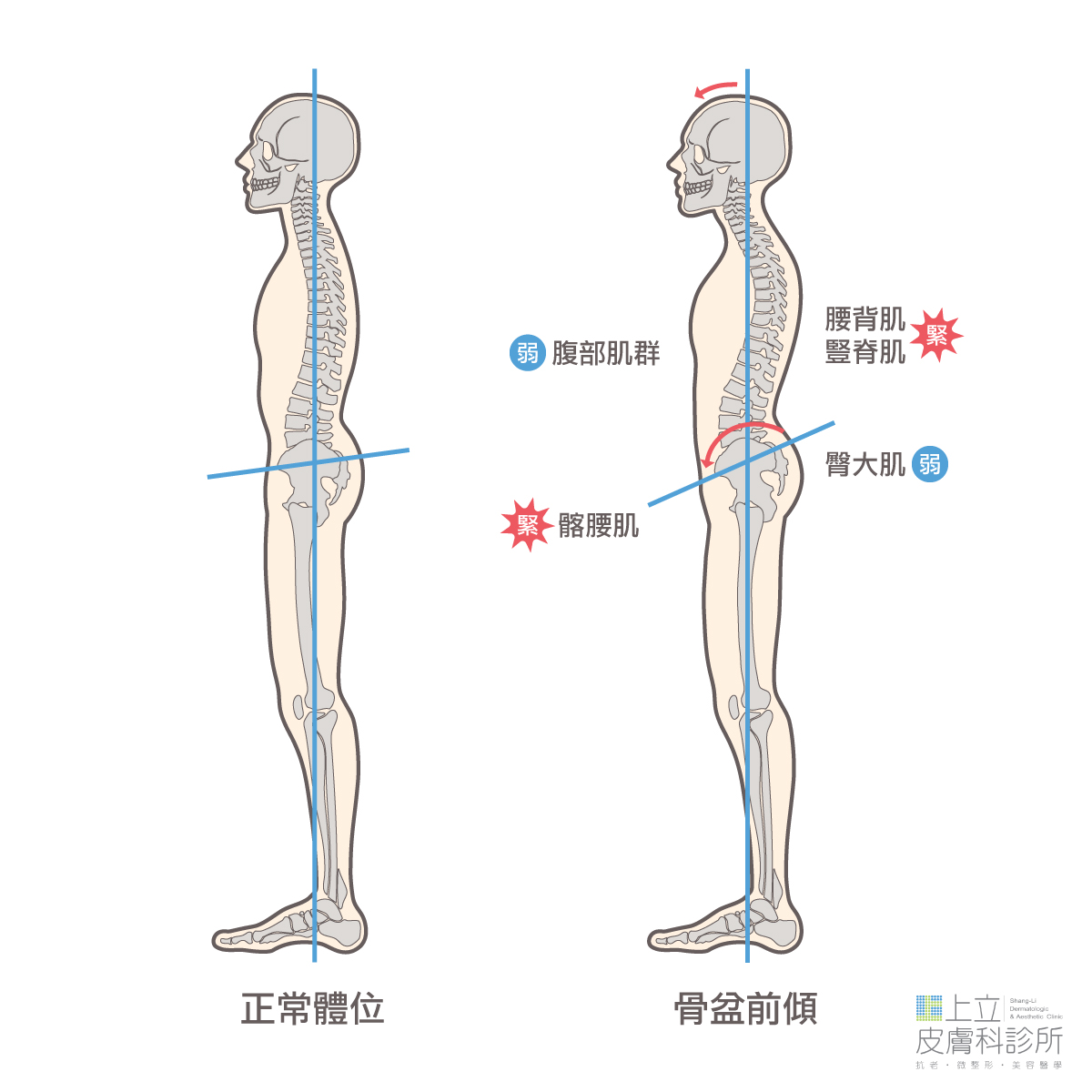 正常體位和骨盆前傾比較