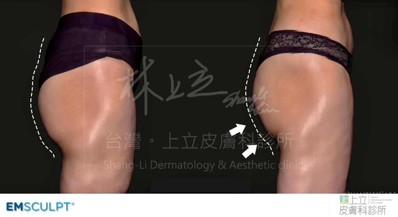 EMSCULPT肌動減脂三次治療之後，隨著臀大肌增加，臀線也有明顯提升。