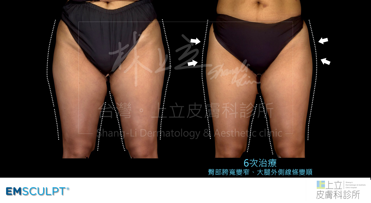 EMSCULPT治療後明顯看出鬆弛的腿部肌肉變得緊緻，回復年輕時的體態狀態。
