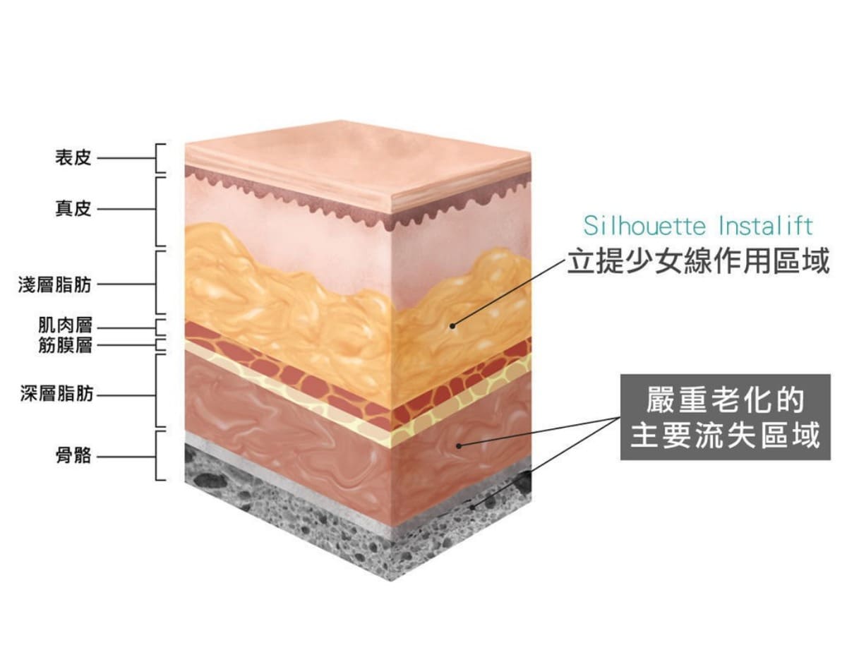 立提少女線作用區域與嚴重老化的皮膚主要流失區域
