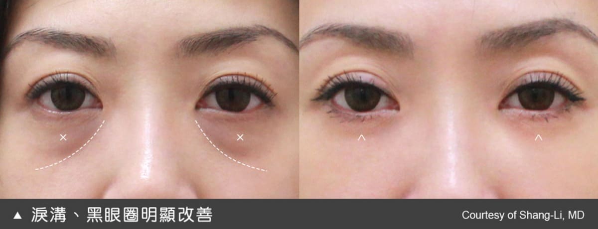 當淚溝改善了，即使沒有打雷射，黑眼圈的情況也明顯淡化很多。