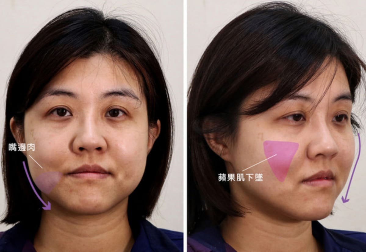 利用少女線結構穩固、抓取面積大的特性，改善蘋果肌下垂