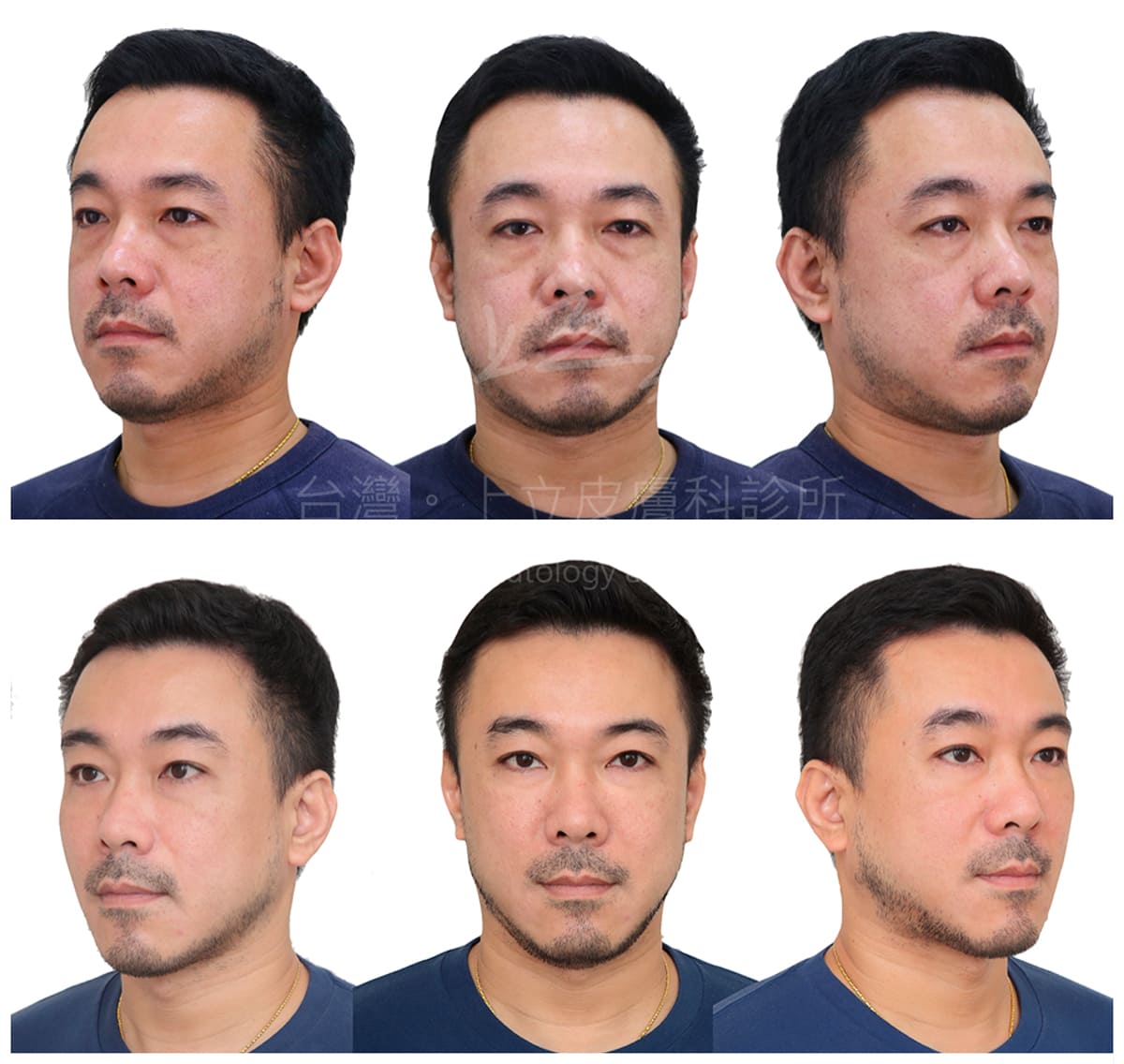 藉由液態拉皮，重建了臉部的體積支撐，改善了淚溝、法令紋