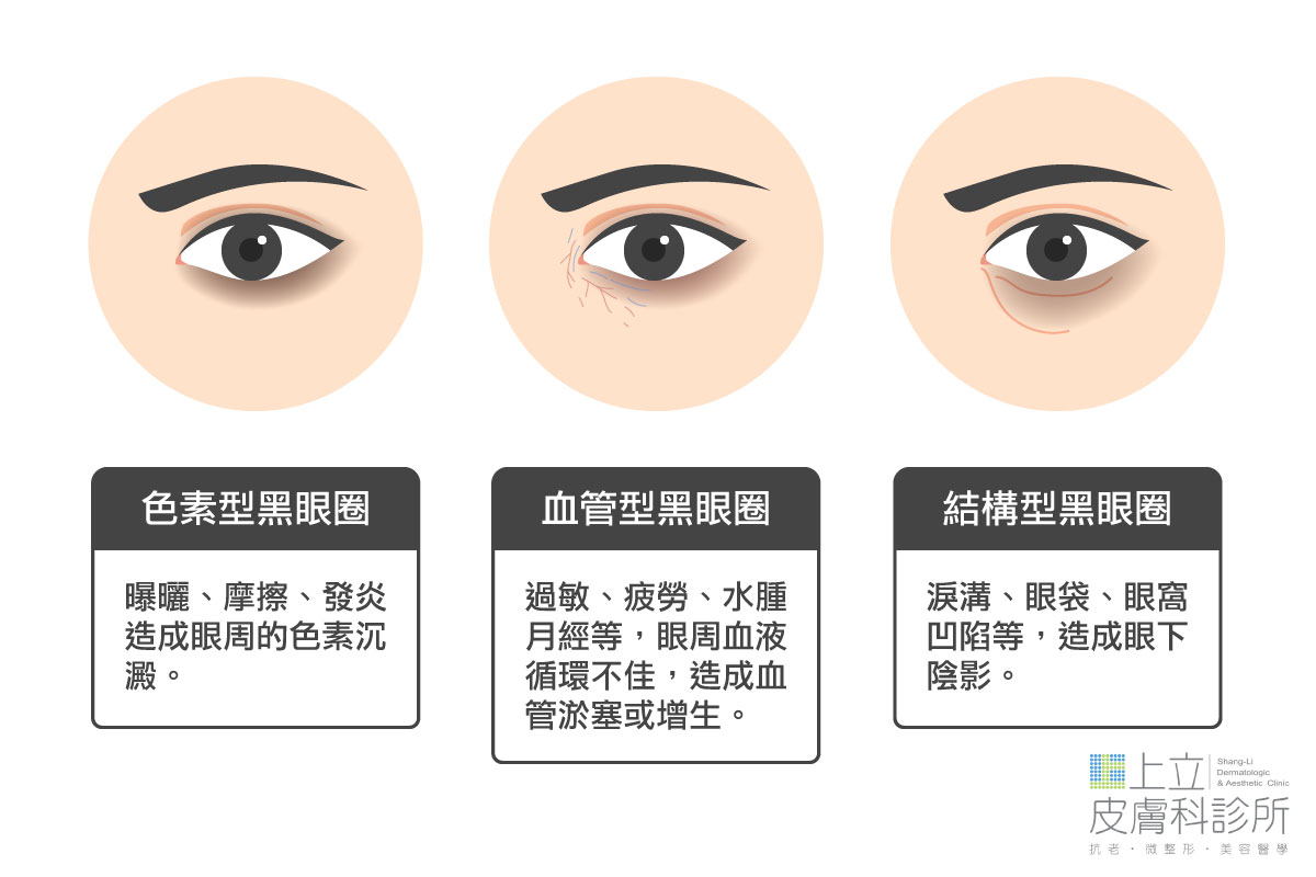色素型黑眼圈和血管型黑眼圈與結構型黑眼圈比較