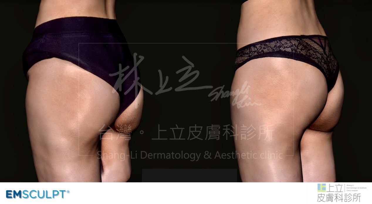 EMSCULPT肌動減脂鍛鍊臀大肌，不只臀線變緊實，連大腿都有收緊之感。