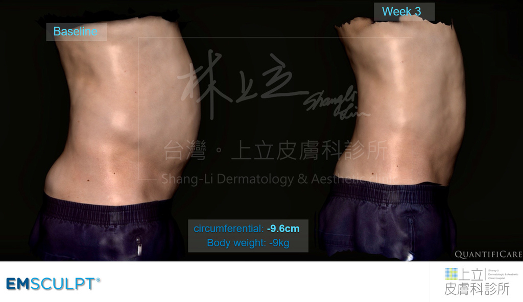 EMSCULPT肌動減脂4個小時的治療後，腹部已顯現出明顯的肌肉線條。