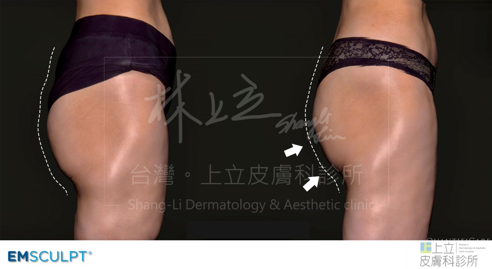EMSCULPT肌動減脂三次治療之後，隨著臀大肌增加，臀線也有明顯提升。