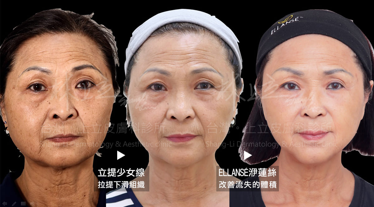 合埋線拉提與注射治療的優勢，不只將鬆弛輪廓往上拉提，隨著深層脂肪和骨架的體積支撐被重建起來，臉部的凹陷皺紋也獲得明顯改善。
