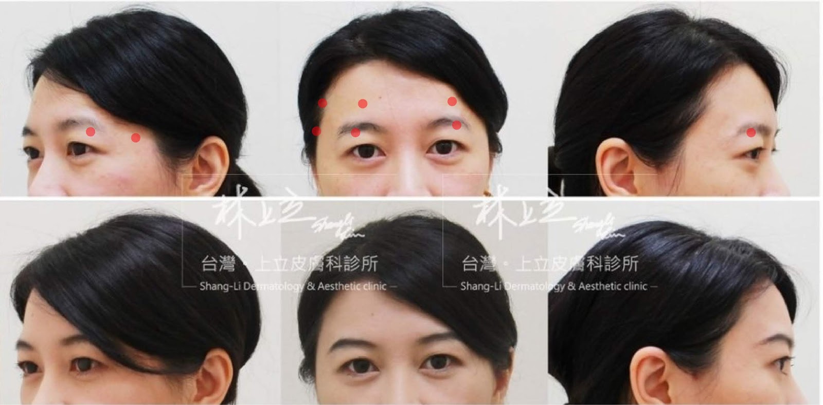 Ellans&eacute;洢蓮絲施打於眼周老化流失的部位，淚溝馬上離去，重現年輕活力。