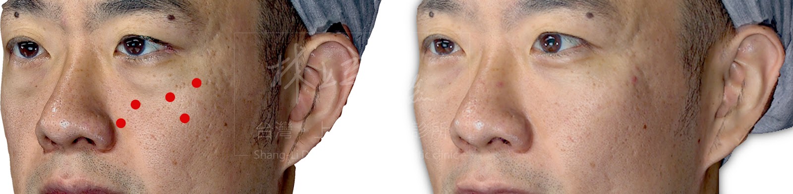 一點一點地將Ellans&eacute;洢蓮絲堆疊在對的淚溝位置，一層一層找回流失的骨架及脂肪。