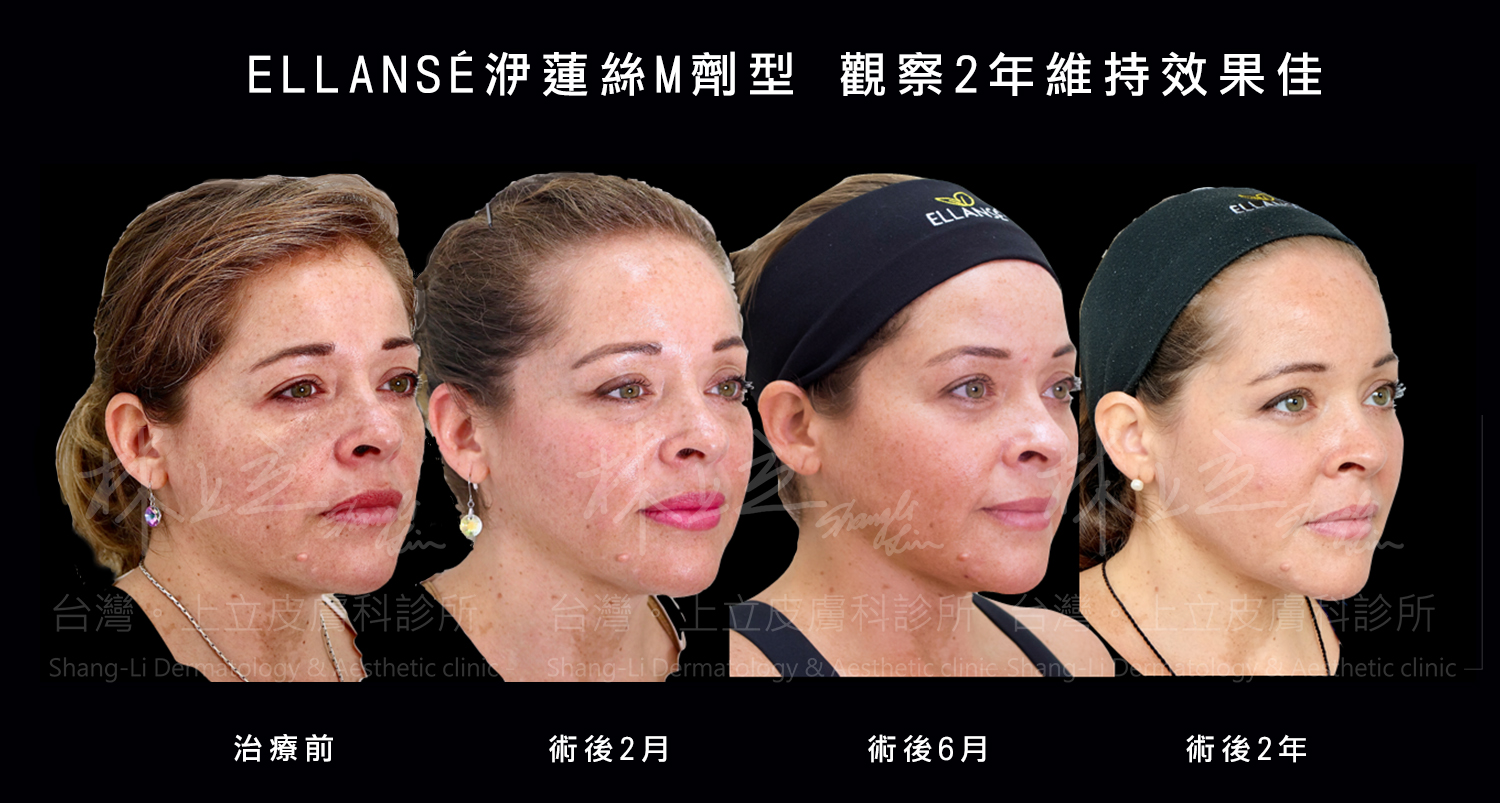 洢蓮絲Ｍ劑型可以持續刺激膠原新生2年之久，臉部的下垂、鬆弛都有明顯改善。