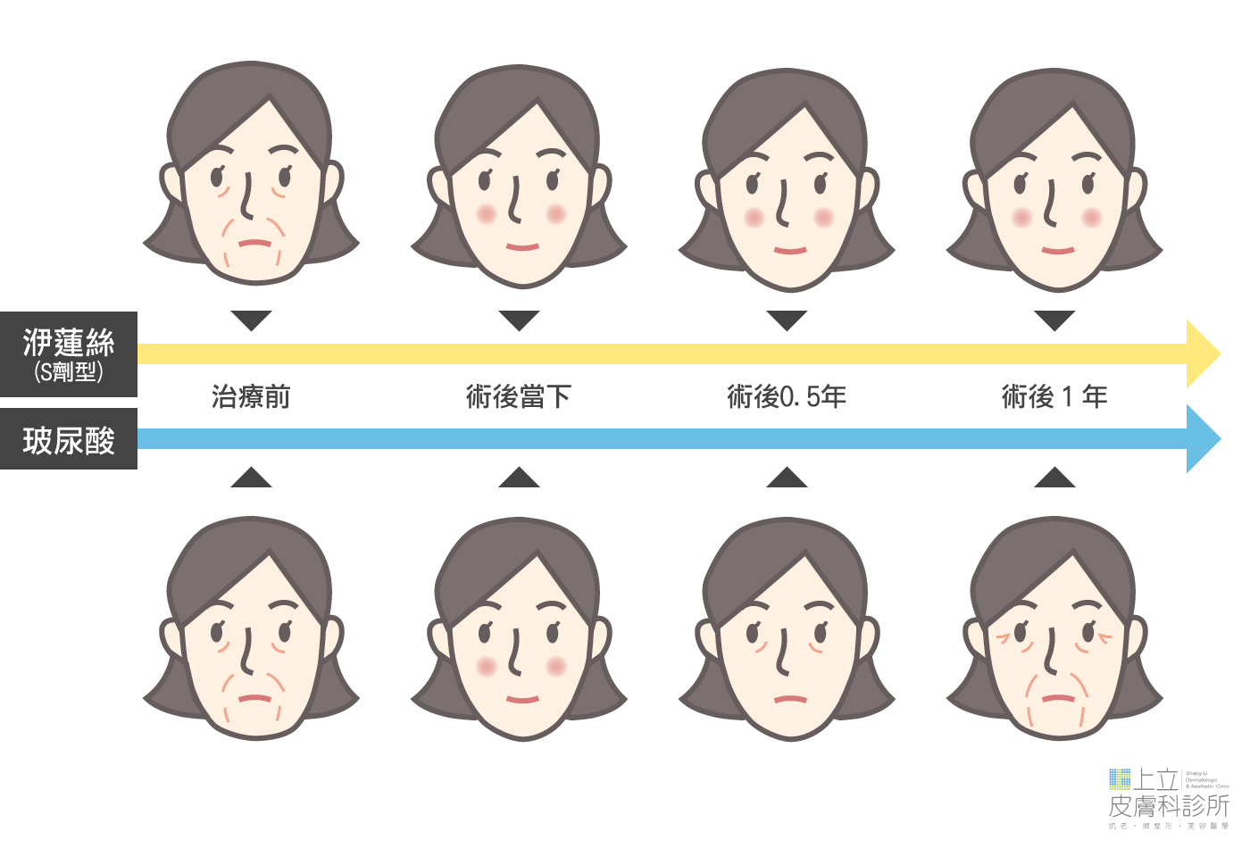 比較玻尿酸和洢蓮絲維持效果