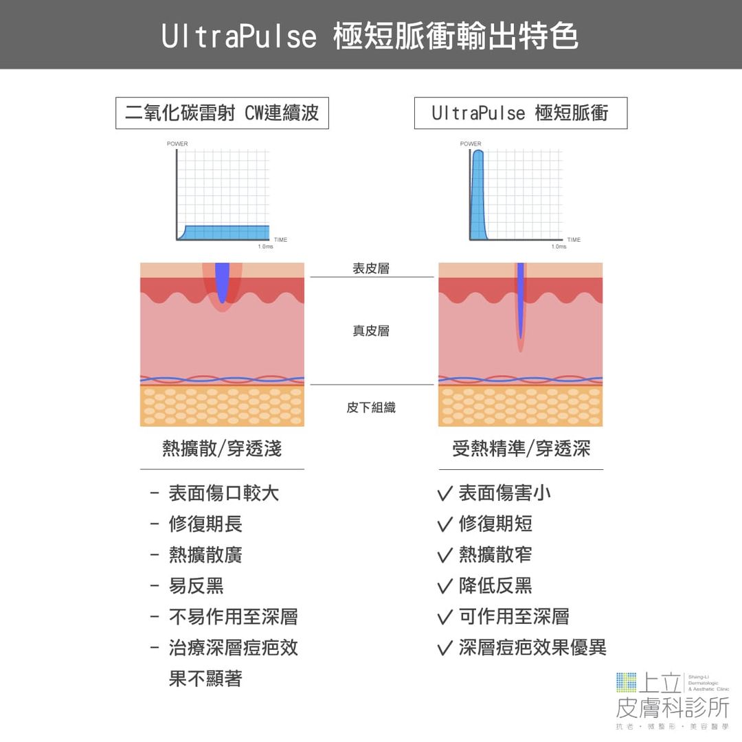 UP雷射極短脈衝輸出特色穿透深，深層逗疤效果優異