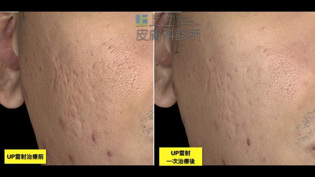 UP雷射治療一次後，膚質細緻、痘疤深度也淺了許多