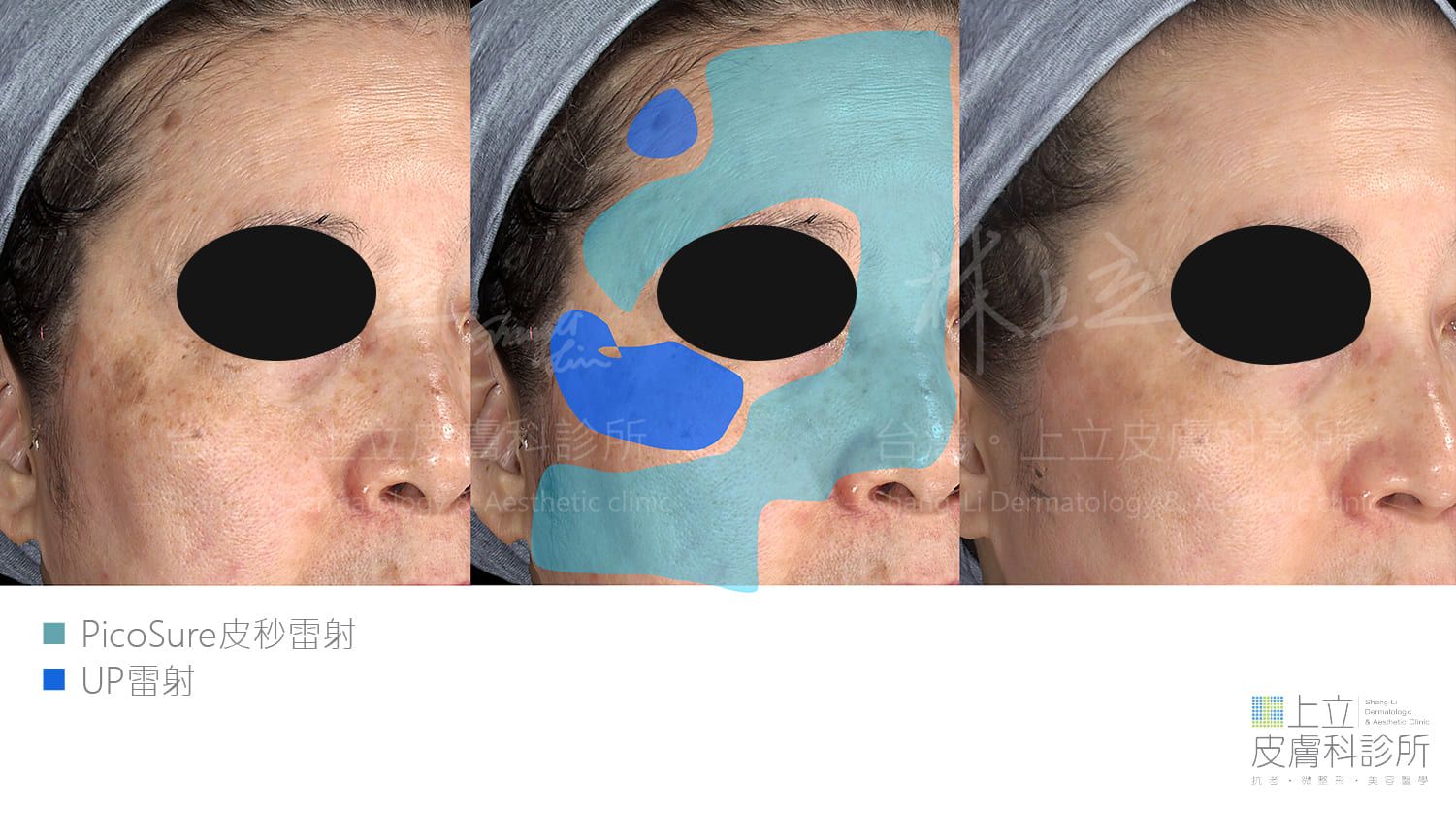 PicoSure 755蜂巢皮秒雷射大範圍處理細紋，ＵＰ雷射則真對局部粗大毛孔皺紋改善