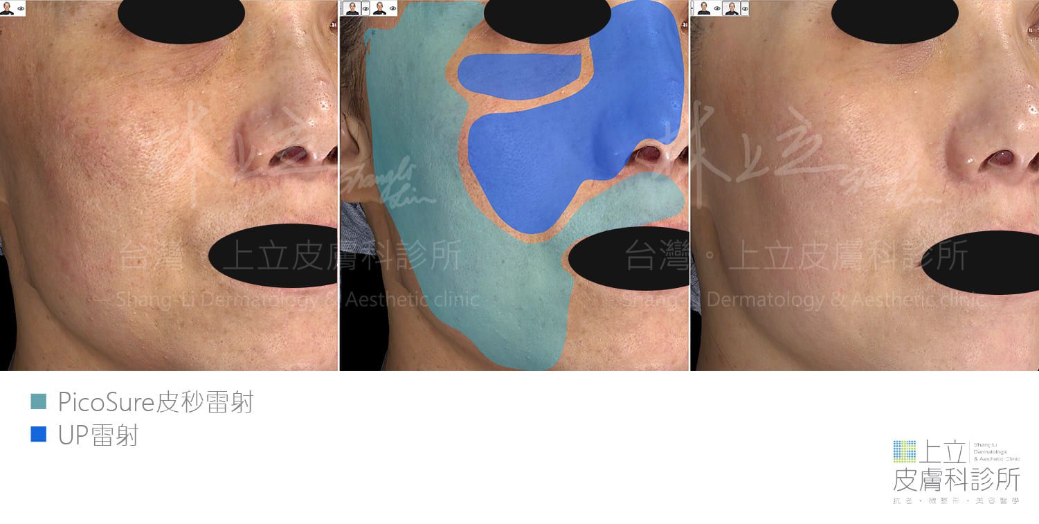 PicoSure 755蜂巢皮秒雷射大範圍細緻膚質，以UP雷射加強，治療一次後的效果滿意度高