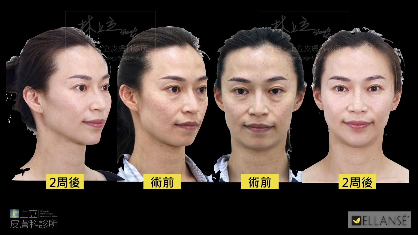 Ellans&eacute;洢蓮絲可以改善臉上的各種紋路，如淚溝