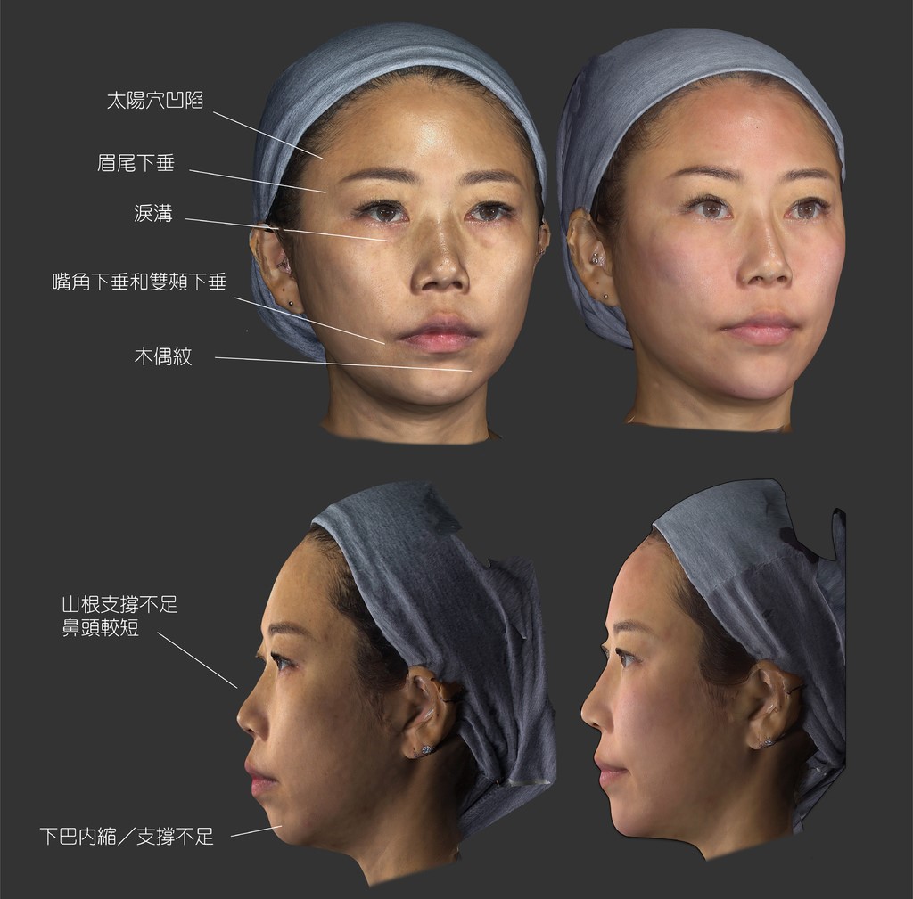 AestheFill艾麗斯（聚雙旋乳酸）重建臉部的骨架支撐，不只五官變得更加立體、輪廓線條更精緻