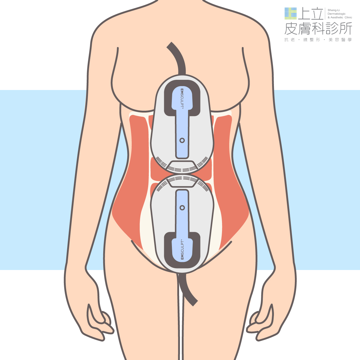 EMSCULPT增肌減脂探頭上下擺放