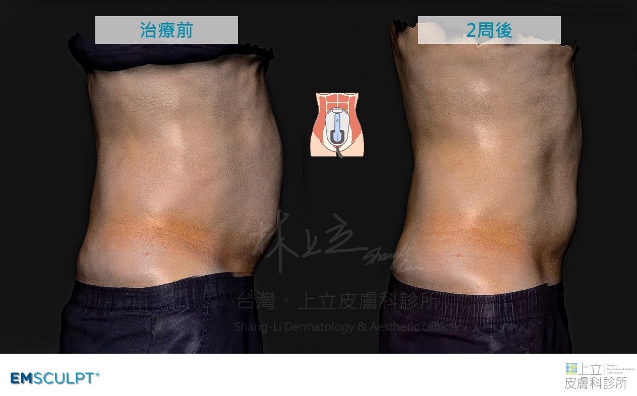 EMSCULPT肌動減脂（肌動翹臀）治療兩週後減少皮下脂肪、內臟脂肪，腰圍變小