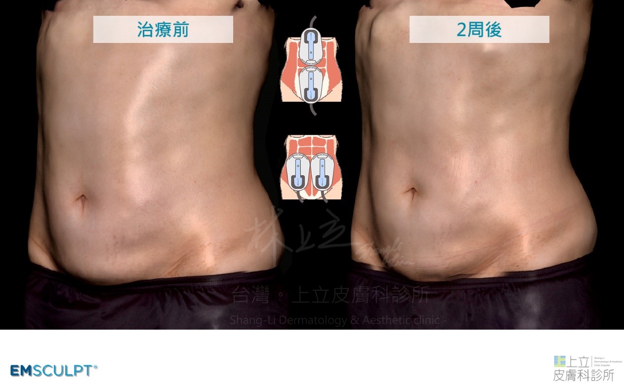 EMSCULPT肌動減脂的探頭強化兩側腰部線條，同時使下腹部變小