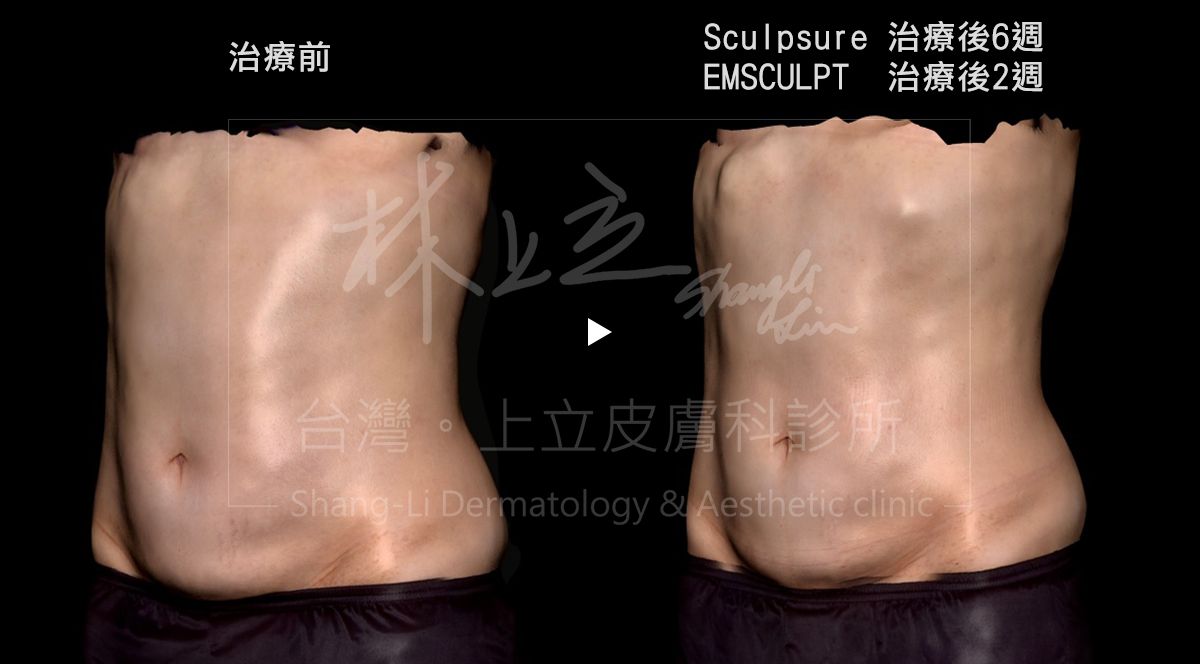 腹部肌肉SculpSure絲酷秀治療後6週與EMSCULPT肌動減脂治療後2週