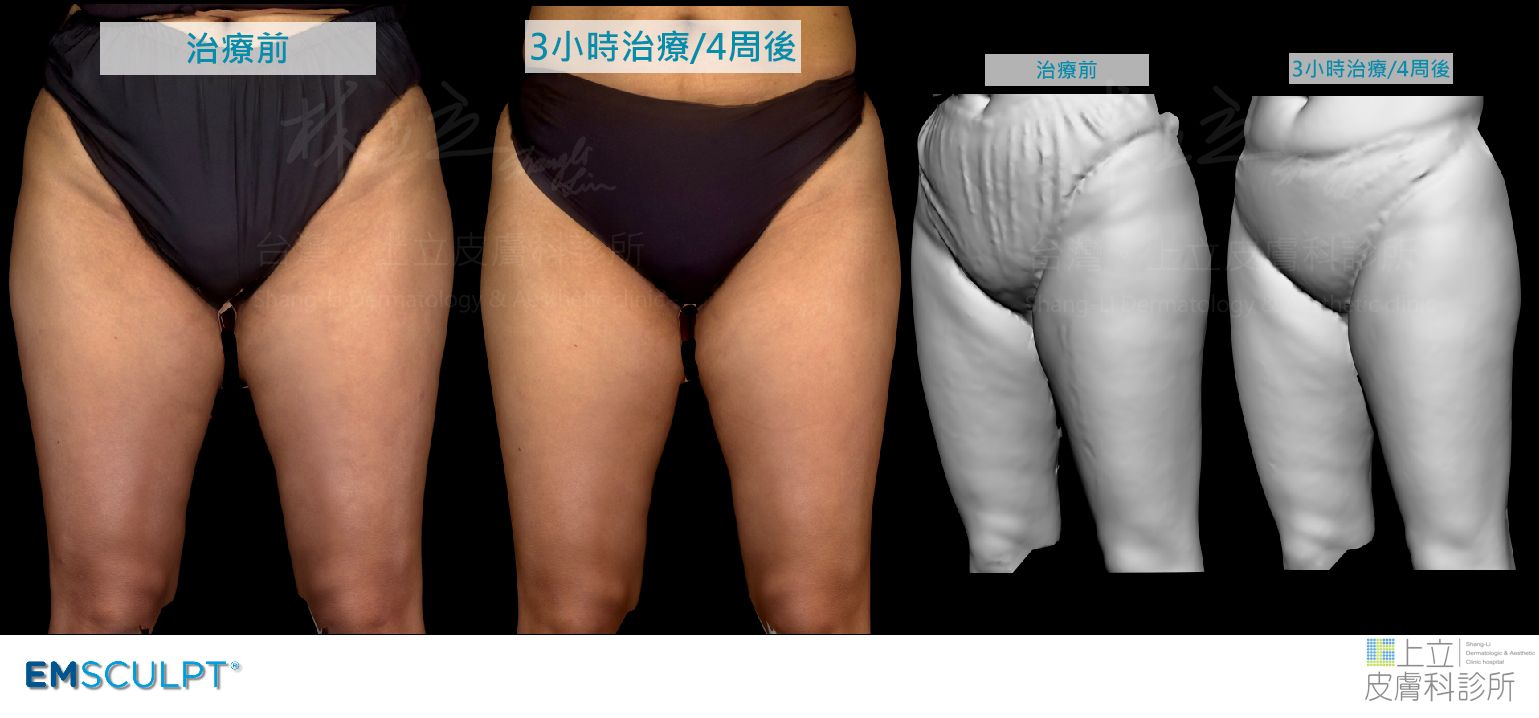 EMSCULPT3小時的治療，四週後發現，因為脂肪減少，肌肉張力增加了