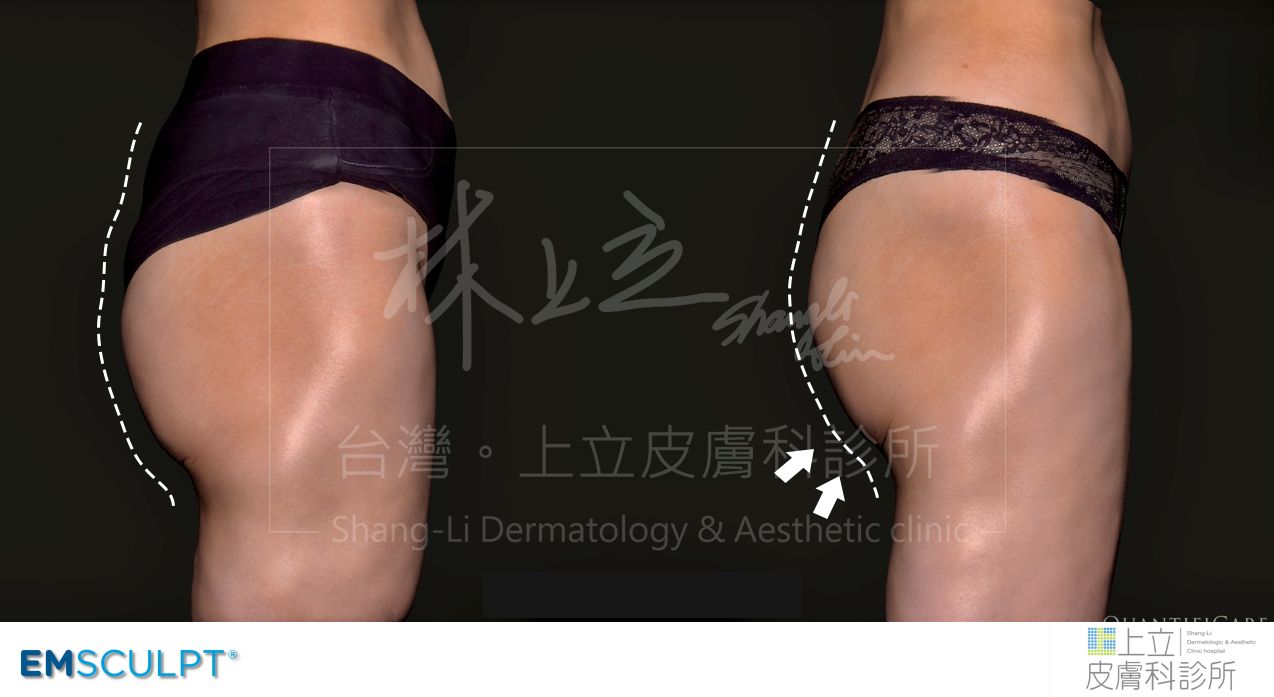 EMSCULPT肌動減脂（肌動翹臀）治療前後，隨著頓部肌肉量增加，臀線明顯往上提。