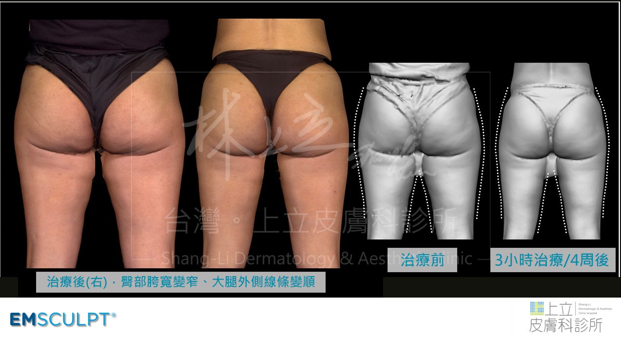 EMSCULPT肌動減脂的六次治療之後，不只大腿變細、結實勻稱，下臀微笑線出現