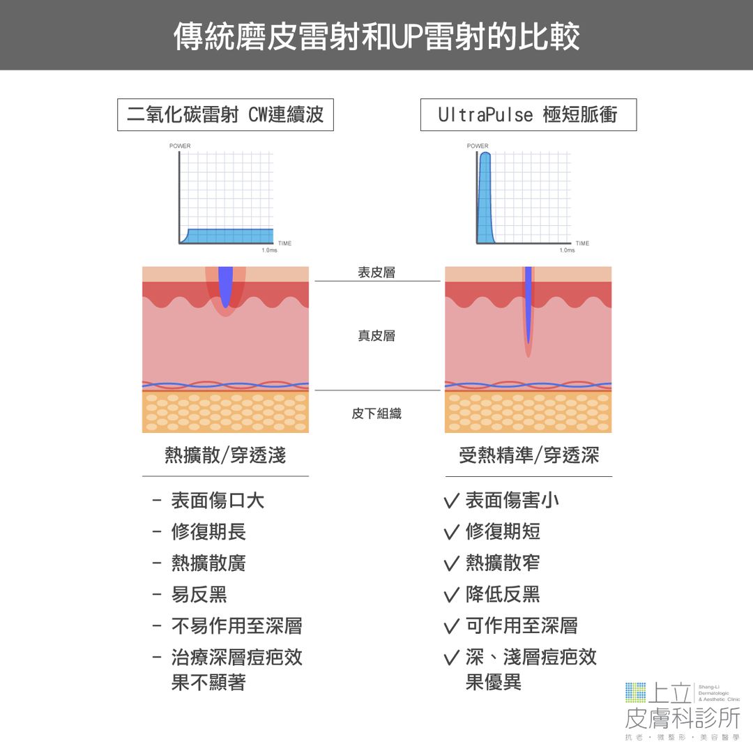傳統磨皮雷射和UP雷射的比較，能量精準、快速、俐落的深入皮下近 4mm