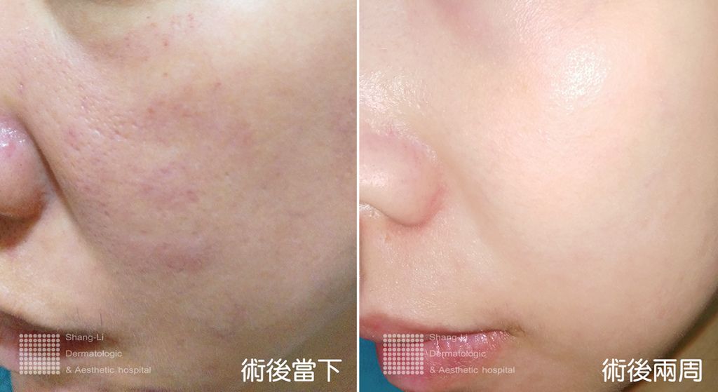 皮秒雷射毛孔縮小、膚色亮白，皮膚整體更健康，且因為沒有修復期，快速享有好皮膚的結果