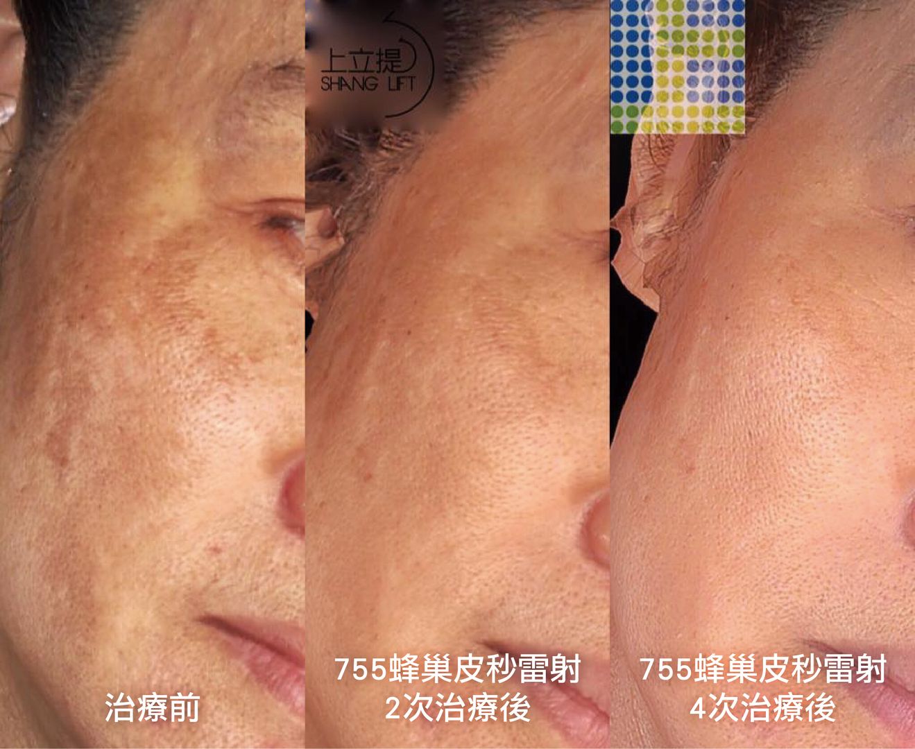 755蜂巢皮秒雷射所產生的LIOB效應，可以刺激皮膚淺層的膠原蛋白新生