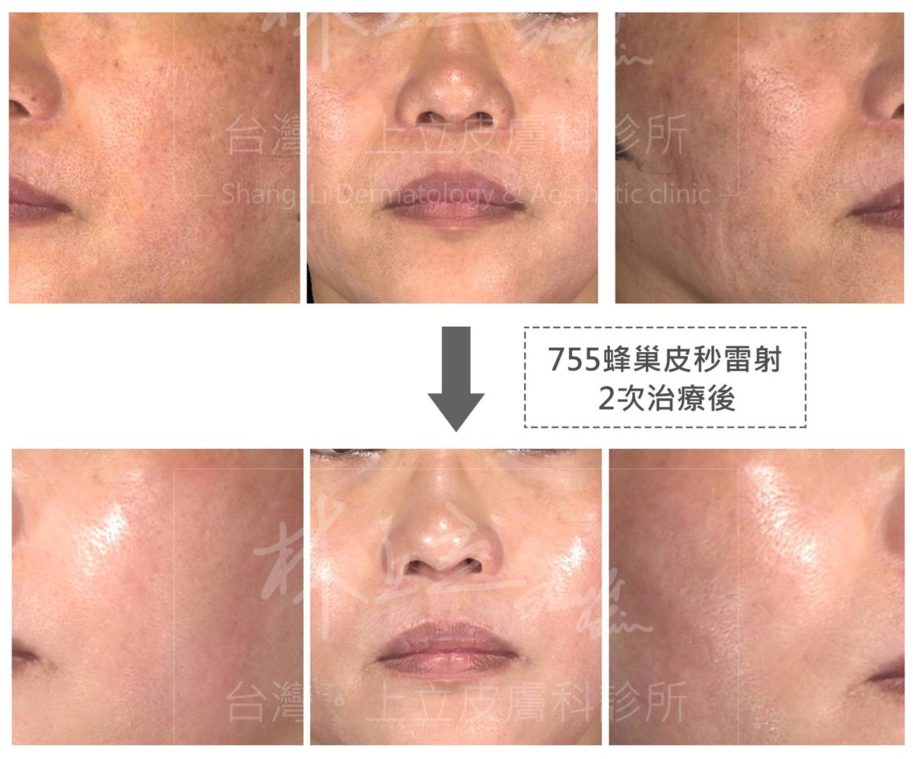 755蜂巢皮秒雷射對於改善膚質、毛孔粗大具有很好的效果。