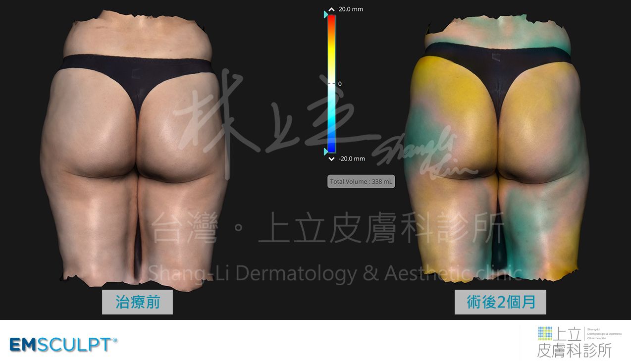 術後2個月，大腿體積減少，臀部肌肉強度變強，臀形看起來變集中、變翹。