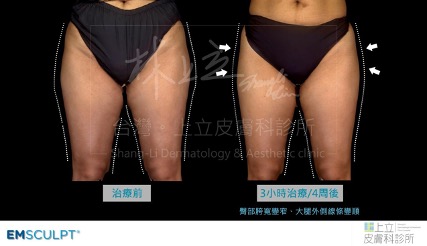 EMSCULPT六次治療後變結實，大腿外側線條明顯變得更順，整體看來更細、更勻稱。